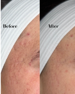 Close-up before and after of a woman’s eye area and forehead.