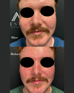 Before and after comparison of a man’s jawline and facial hair area treatment.