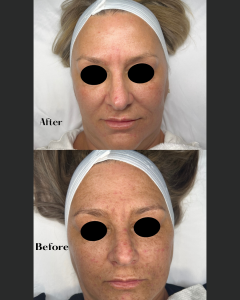 before and after showing results of a facial skin treatment on a woman.