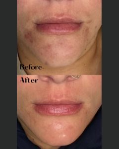 Profile before and after of a woman’s chin and acne treatment.