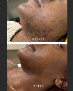 Front view before and after of a woman’s neck and hair removal.