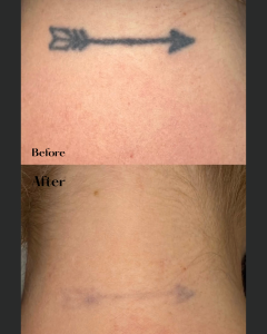 Before and after of a skin pigment or tattoo removal treatment on the neck.