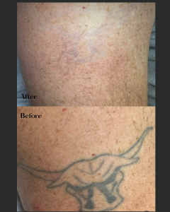 Before and after of a skin pigment or tattoo removal treatment on the arm.