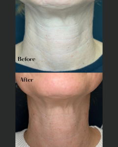 Before and after of a woman’s neck skin rejuvenation treatment.