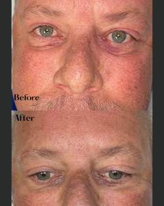 Close-up before and after of a man’s nose and cheeks showing reduction in skin redness.