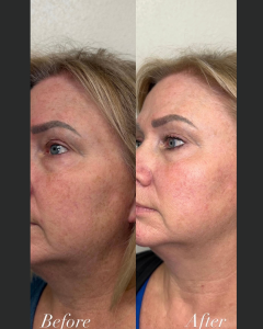 Side profile before and after of a woman’s jawline and neck tightening treatment.
